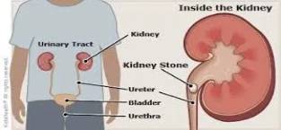 Kidney Stones: Causes and Symptoms in Aurangabad & Pune