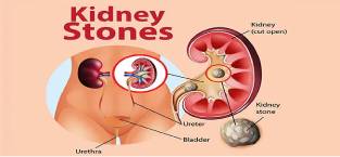 5 Effective ways to remove kidney stones without surgery in Aurangabad & Pune