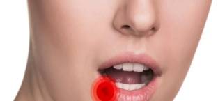 Homoeopathy Treatment for Cold sores in Aurangabad & Pune