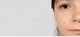 5 Effective Homoeopathy Treatments for Acne in Aurangabad & Pune
